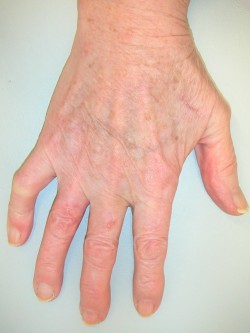 Vrij transplantaat vinger