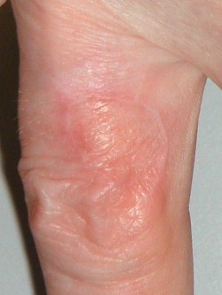 Vrij transplantaat vinger