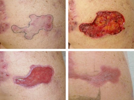 Secundaire wondgenezing