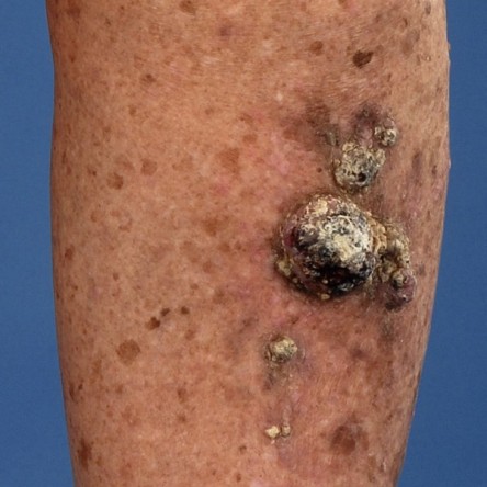 Secundaire wondgenezing