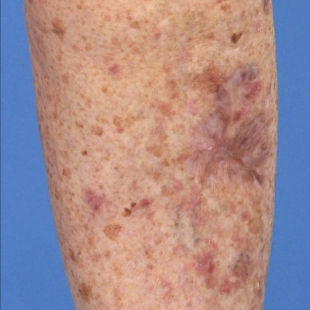 Secundaire wondgenezing