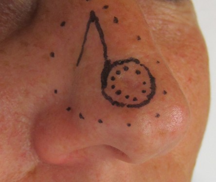 Single lobed transposition flap