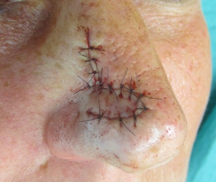 Single lobed transposition flap