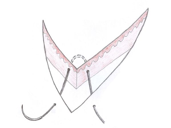 Corner stitch Corner stitch