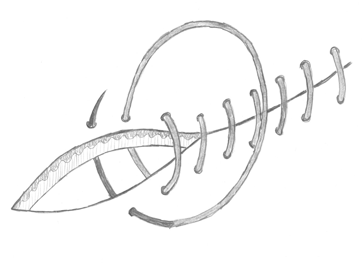 Doorlopende transcutane hechting Doorlopende transcutane hechting