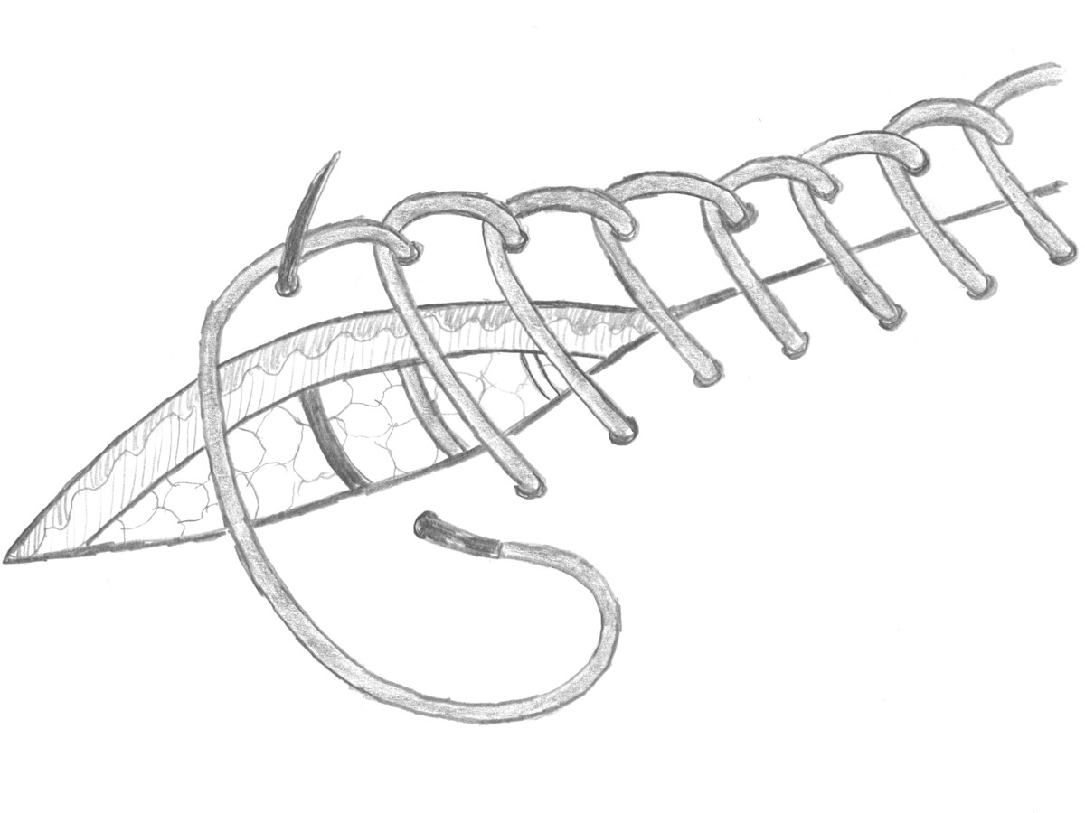Doorlopende transcutane hechting, interlocked Doorlopende transcutane hechting, interlocked