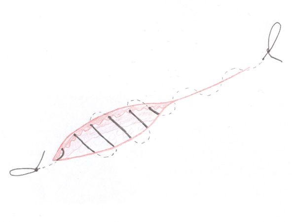 Doorlopende intracutane hechting Doorlopende intracutane hechting