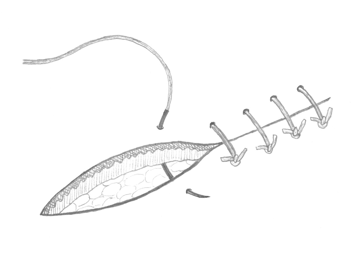 Normale transcutane hechting Normale transcutane hechting