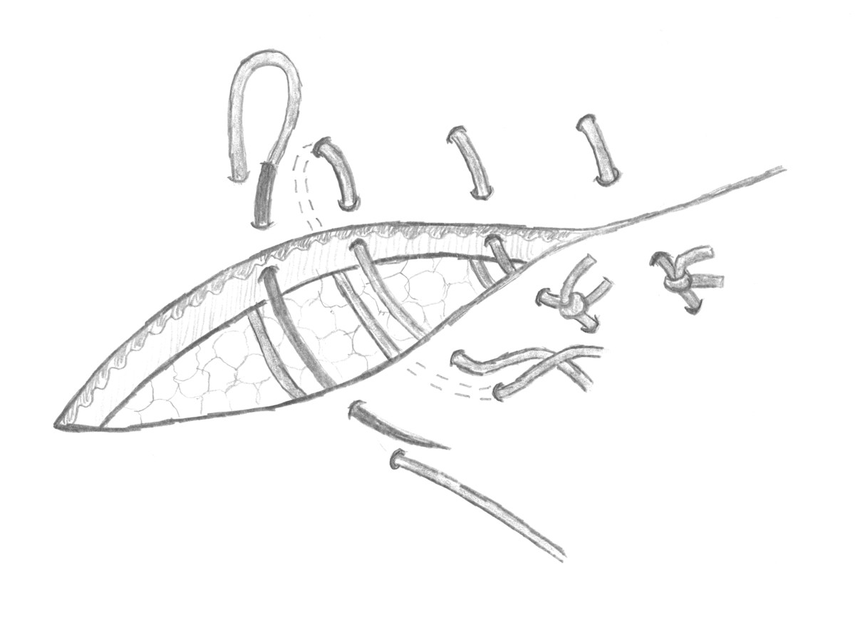 Verticale matrashechting Verticale matrashechting