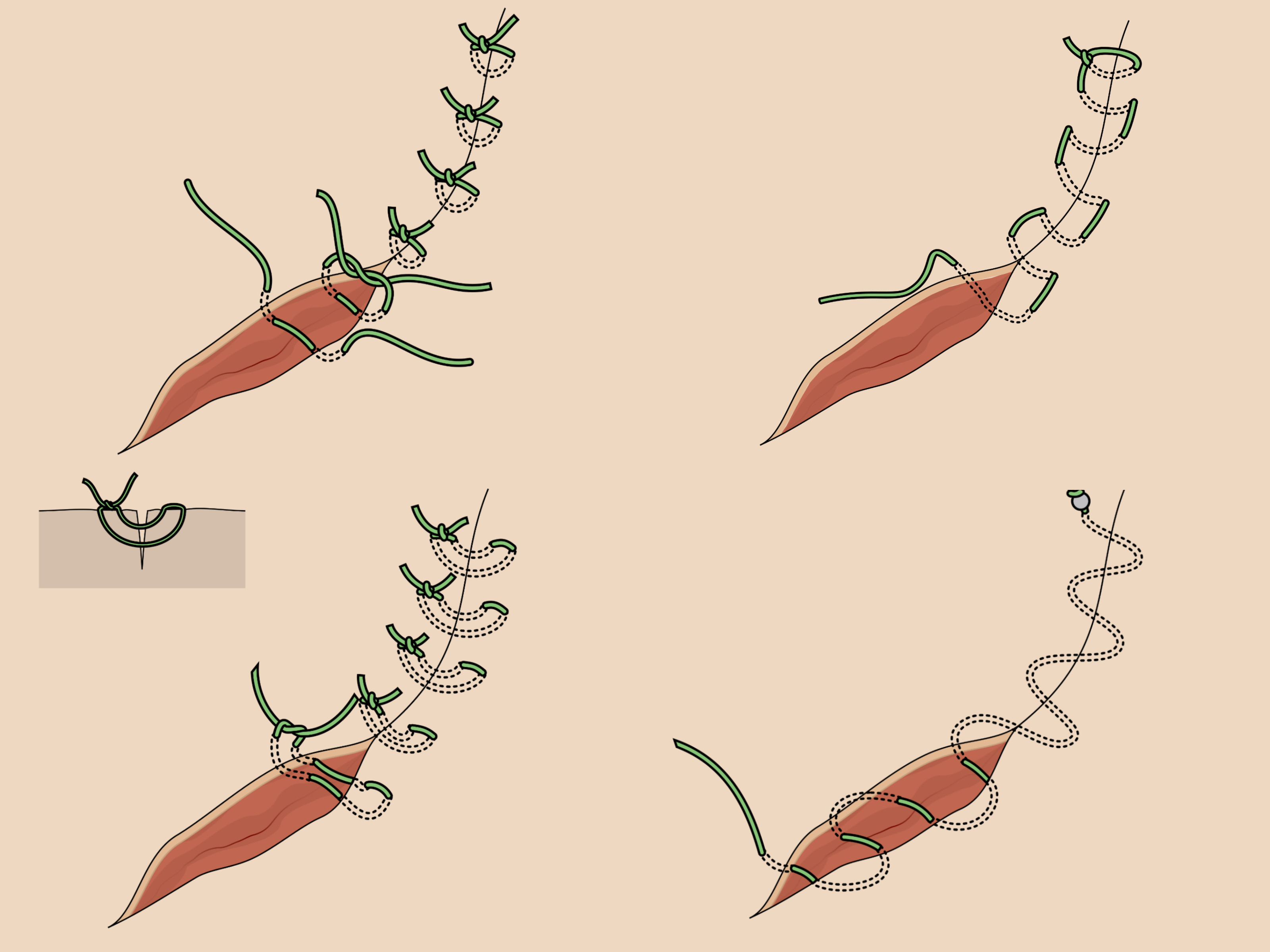 Transcutane en intracutane hechtingen