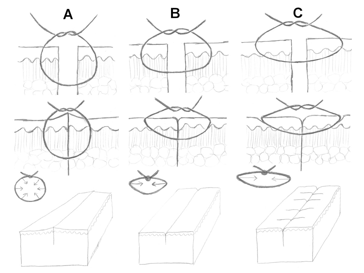 Transcutane hechtingen (klik op afbeelding om video te zien) Transcutane hechtingen