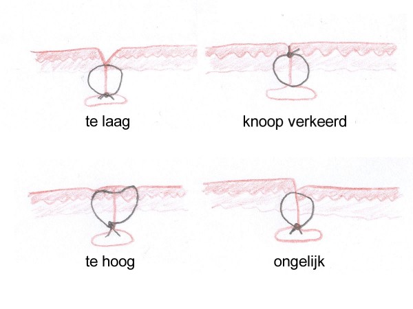 Subcutane hechting Subcutane hechting