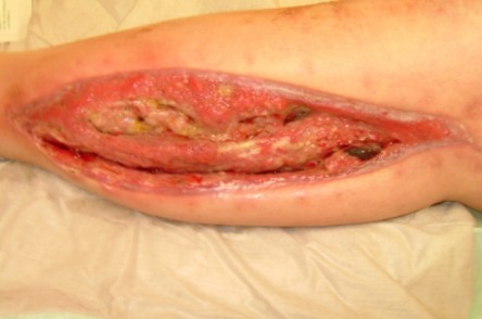 Vacuum Assisted Closure (VAC)