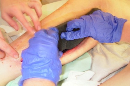 Vacuum Assisted Closure (VAC)