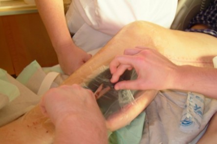 Vacuum Assisted Closure (VAC)