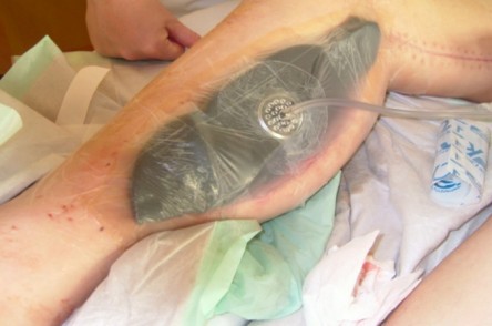 Vacuum Assisted Closure (VAC)