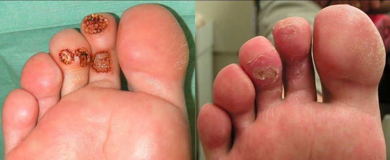 Elektrocoagulatie van voetwratten