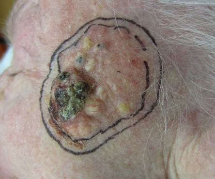 Full thickness graft