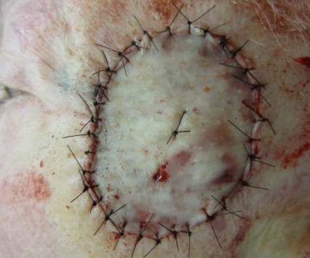 Full thickness graft