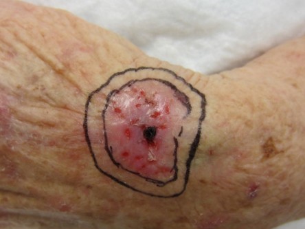 Full thickness graft