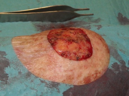 Full thickness graft