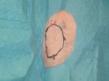 Full thickness graft