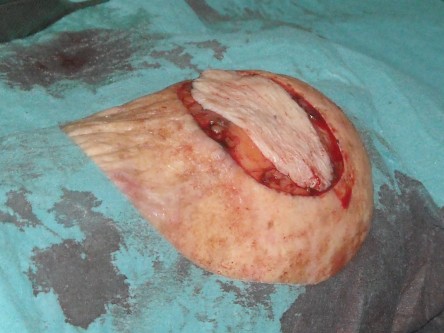 Full thickness graft