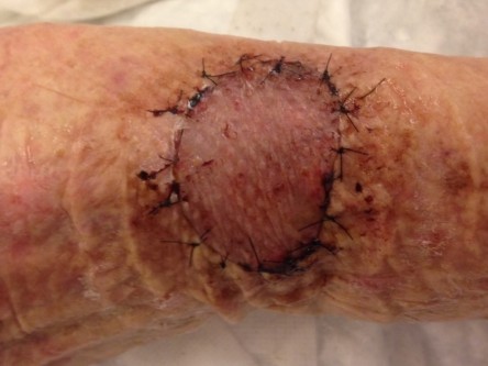 Full thickness graft