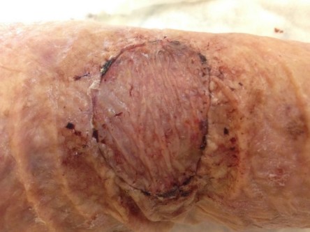 Full thickness graft