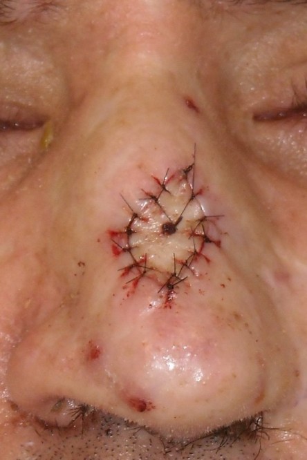 Full thickness graft