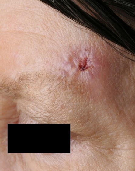 Full thickness graft