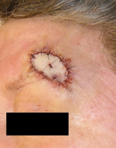 Full thickness graft