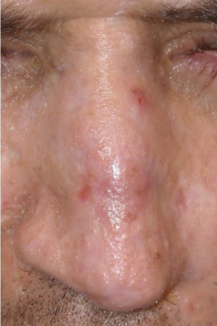 Full thickness graft