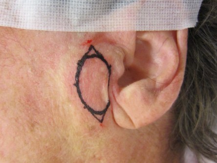 Full thickness graft