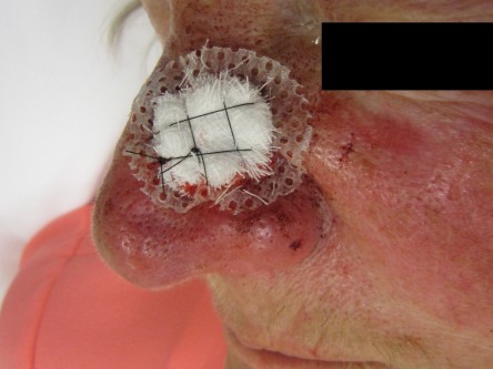 Full thickness graft