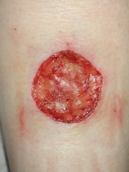 Full thickness graft