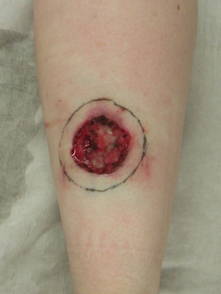 Full thickness graft