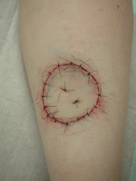 Full thickness graft