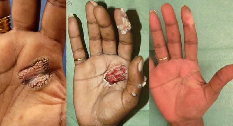 Elektrocoagulatie van handwratten