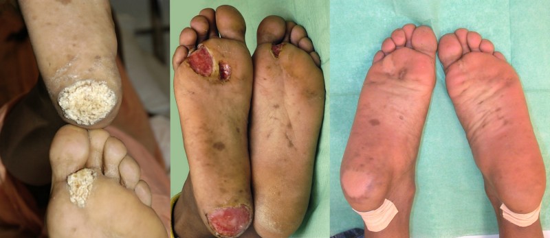 Elektrocoagulatie van voetwratten