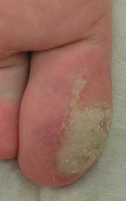 Elektrocoagulatie voetwratten