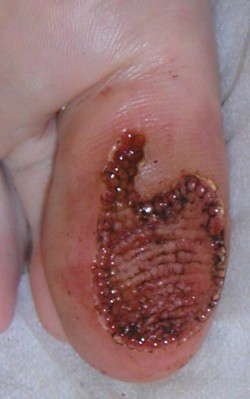 Elektrocoagulatie voetwratten