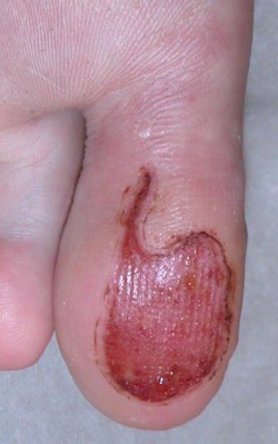 Elektrocoagulatie voetwratten