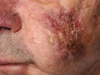 Pyoderma vegetans bij hidradenitis suppurativa