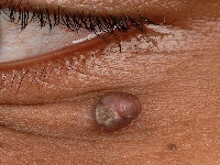 Syringocystadenoma papilliferum