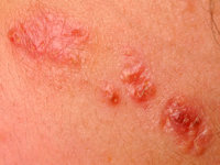 Syringocystadenoma papilliferum