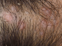 Syringocystadenoma papilliferum