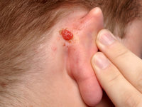 Syringocystadenoma papilliferum