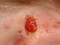 Syringocystadenoma papilliferum