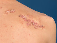 Syringocystadenoma papilliferum